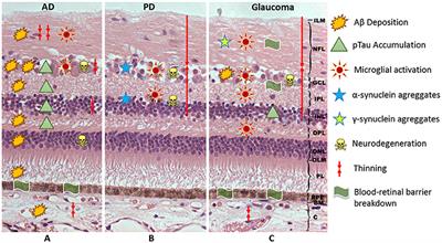 The Role of Microglia in Retinal Neurodegeneration: Alzheimer's Disease, Parkinson, and Glaucoma